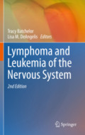 Lymphoma and Leukemia of the Nervous System